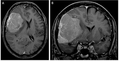 Case report: Use of 68Ga-DOTATATE-PET for treatment guidance in complex meningioma disease